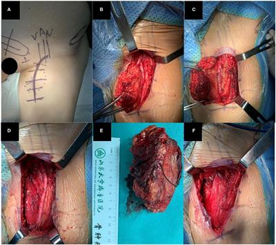 The Pedicled Flap of Adductor Longus, a New Technique for Inguinal Reconstruction